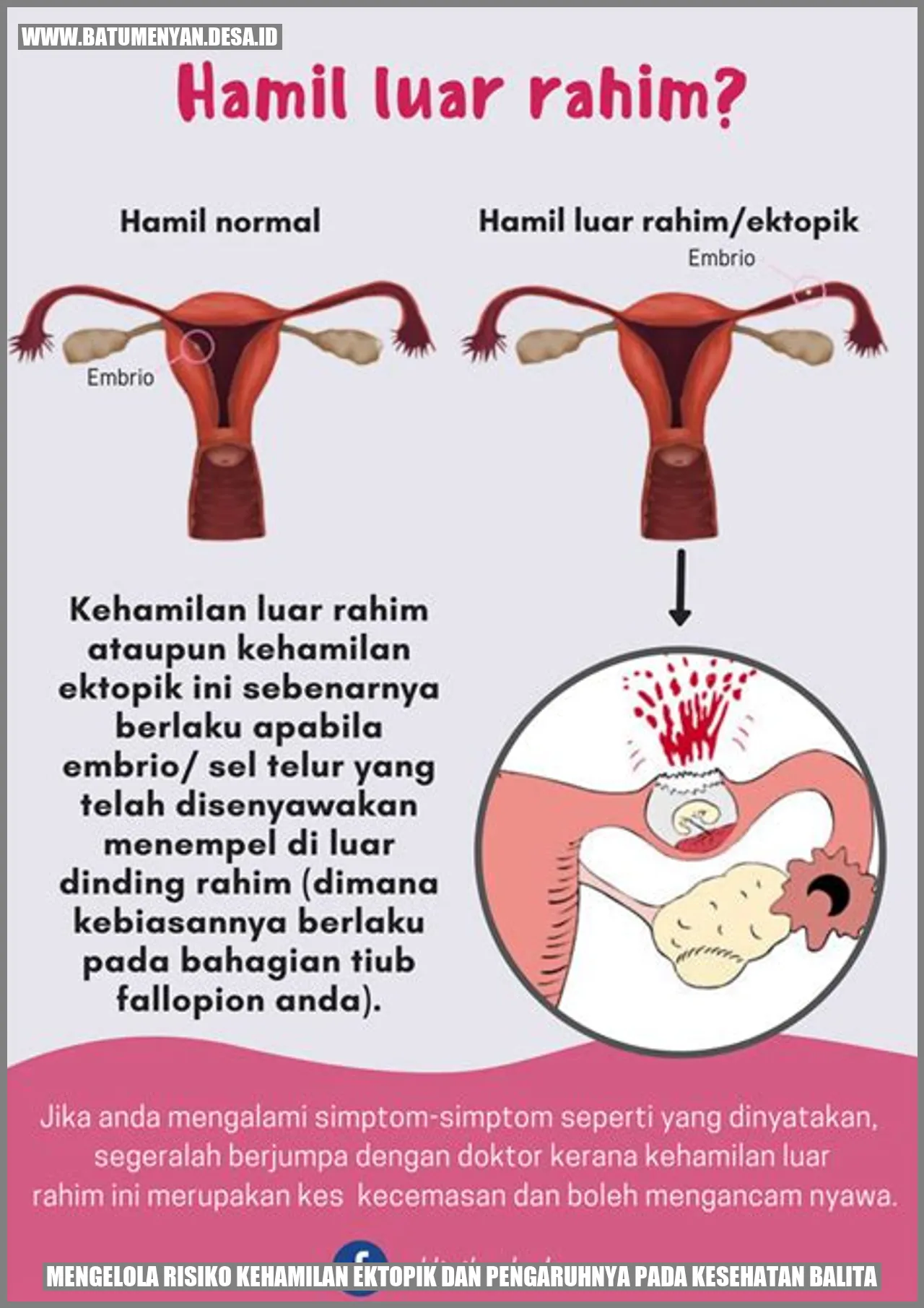 Mengelola Risiko Kehamilan Ektopik dan Pengaruhnya pada Kesehatan Balita